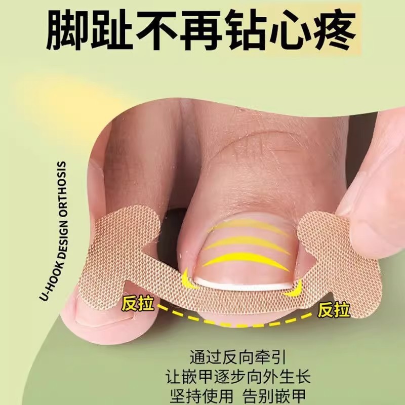 爆款指甲沟矫正贴免胶水快速修脚趾甲变形贴片脚指甲防嵌甲矫正贴|undefined