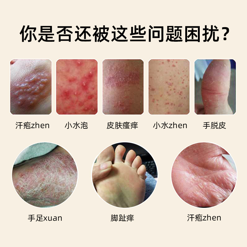 皮膚抗菌クリーム汗かぶれ汗ヘルペスクリーム皮膚掻痒水泡赤発疹皮ヨウ蚊虫刺され百草かゆみ止めクリーム|undefined