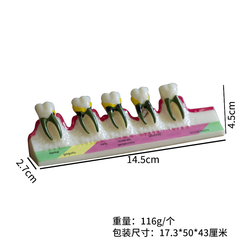 Modelo de clasificación periodontal modelo de caries dental modelo de visualización de caries dental