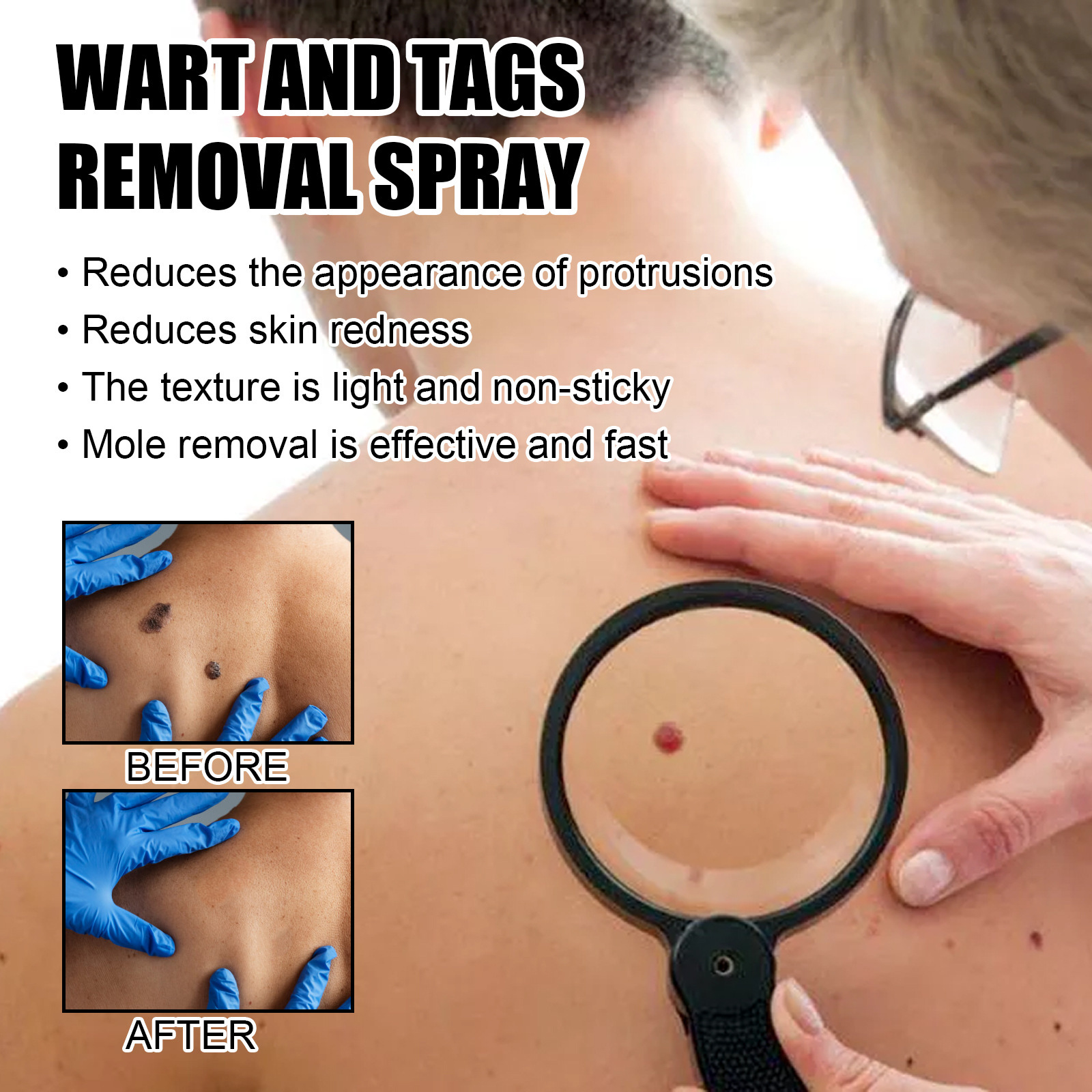 Ximonth蜂毒克いぼ看護スプレーは体をきれいにします。