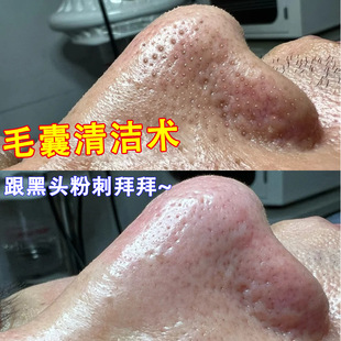 Beauty salon hair follicle purification cream blackhead removing cutin cleansing pores gentle blackhead suction hospital facial massage cream