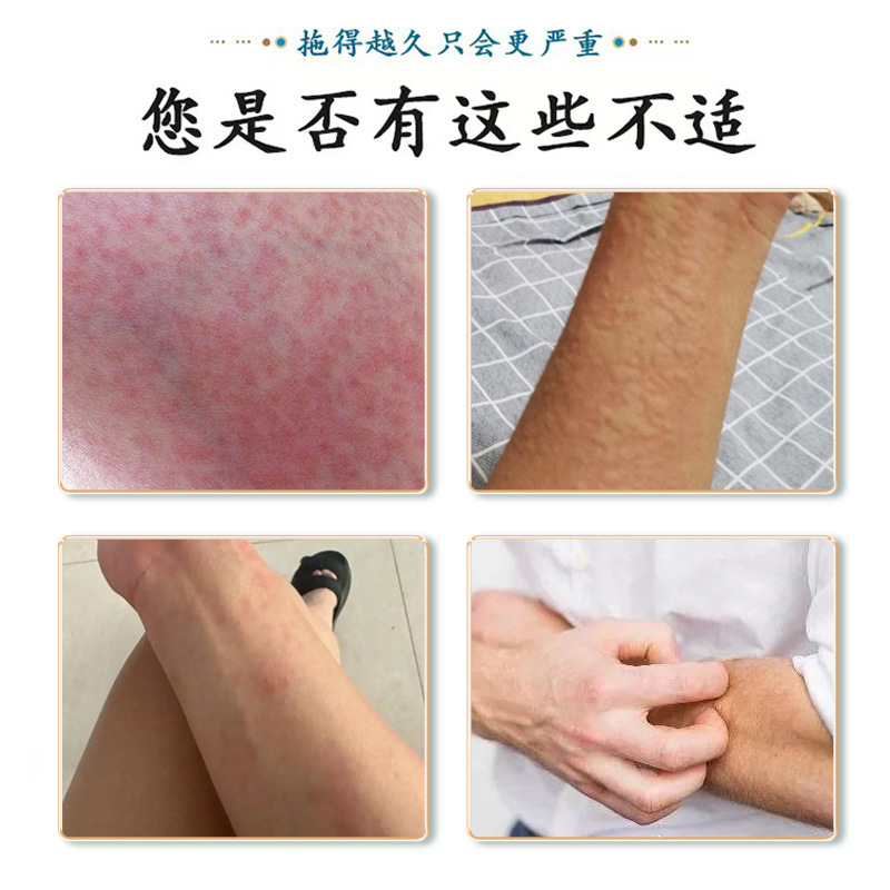 Zhanggu Pharmaceutical 皮膚かゆみ止め イラクサ軟膏 赤い発疹 かゆみ 百草皮膚軟膏 ウェットかゆみクレンジング 全身かゆみ止め軟膏 メーカー|undefined