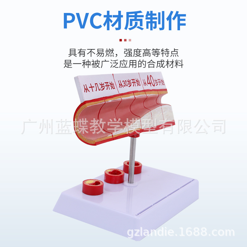 Ѫ�ܷ������Ѫ֬��Ѫ֬ģ�Ͳ�����̬Ӳ������Ѫ˨ֱ�۽�ѧ����