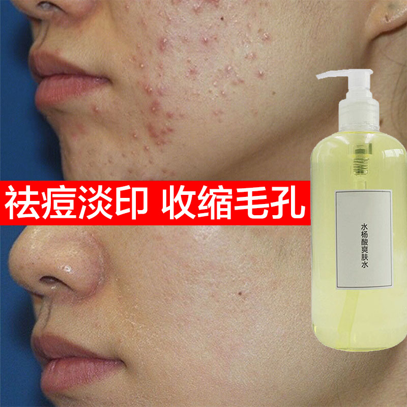 Salicylic Acid Toner, Fruit Acid Essence Brush, Shrinkage Acid, Remove Closed Acne, Blackheads, Enlarged Pores, Remove Acne Marks