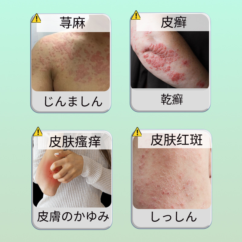 麻アレルギーかゆみ止めクリーム皮膚のかゆみ急性および慢性軟膏免疫力を向上させる皮膚赤点局所健康軟膏|undefined