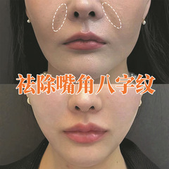 六勝ペプチド原液はシワを引き締めて顔の細目を薄めます。