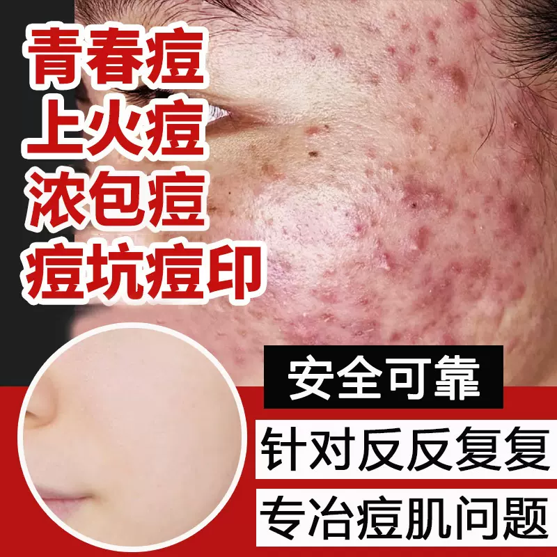 美容院草本祛痘精华液袪痘坑痘印青春痘粉刺改善面部痘肌收缩毛孔