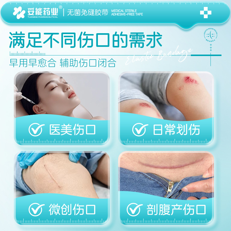 Tuoneng medical steri-Strip напряжение кожи устройство для уменьшения раны вытяжная паста после кесарева сечения дети шрам уменьшение пост