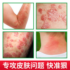 Yang Gong Fang Miao Fang Bai Cao Zhi Yang Gao Herbal Cream Skin Itch Soft Cream Gentle Care Manufacturer Dropshipping One Piece