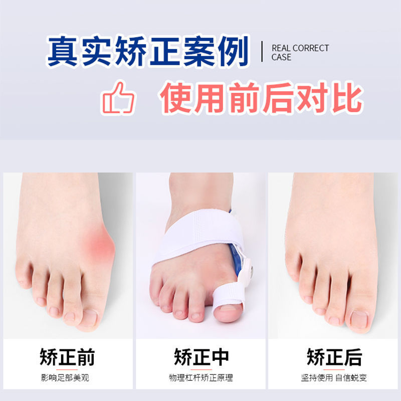 Footwear-friendly toe-overlapping correction device for bunions, suitable for men and women, wearable day and night.