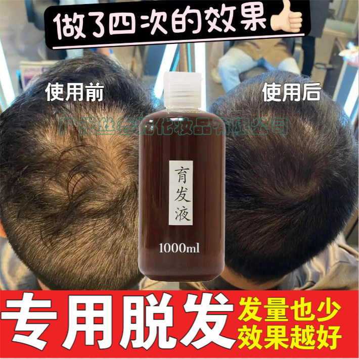 育毛液脱育発精華液成長発密発育発何首烏固発発毛液毛包修復液|undefined