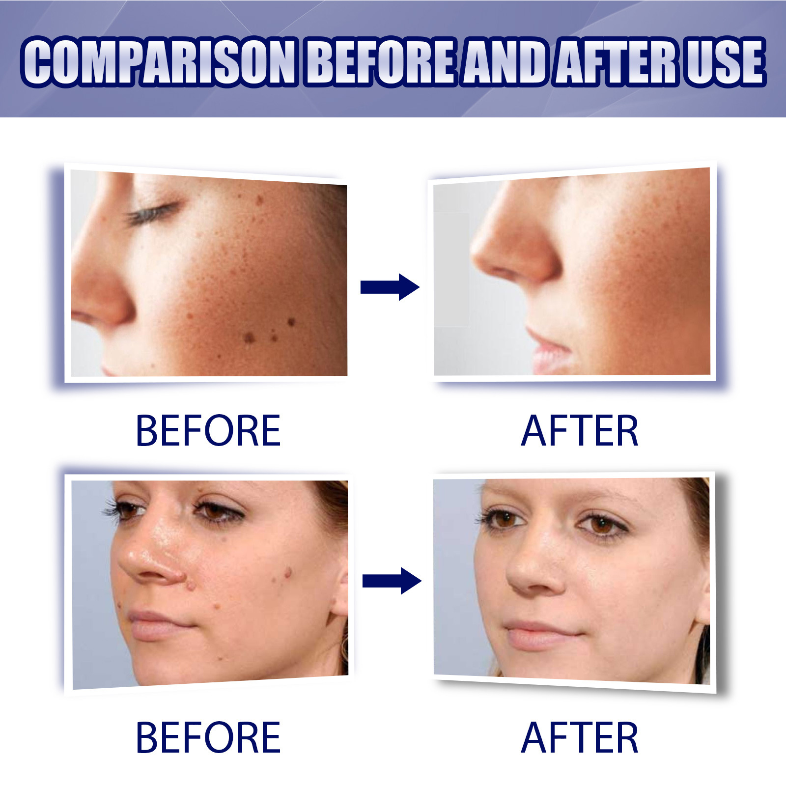 2023 Skin Label Borttagning Kyckling Ögonvård Rengöring Hud, kropp, ansiktsbehandling Flat Youke Wart Cream_voghion.com