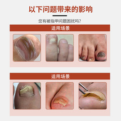 王泰林灰甲康護理液灰指甲亮脫甲軟甲卸甲草本足部專用藥水抑菌液