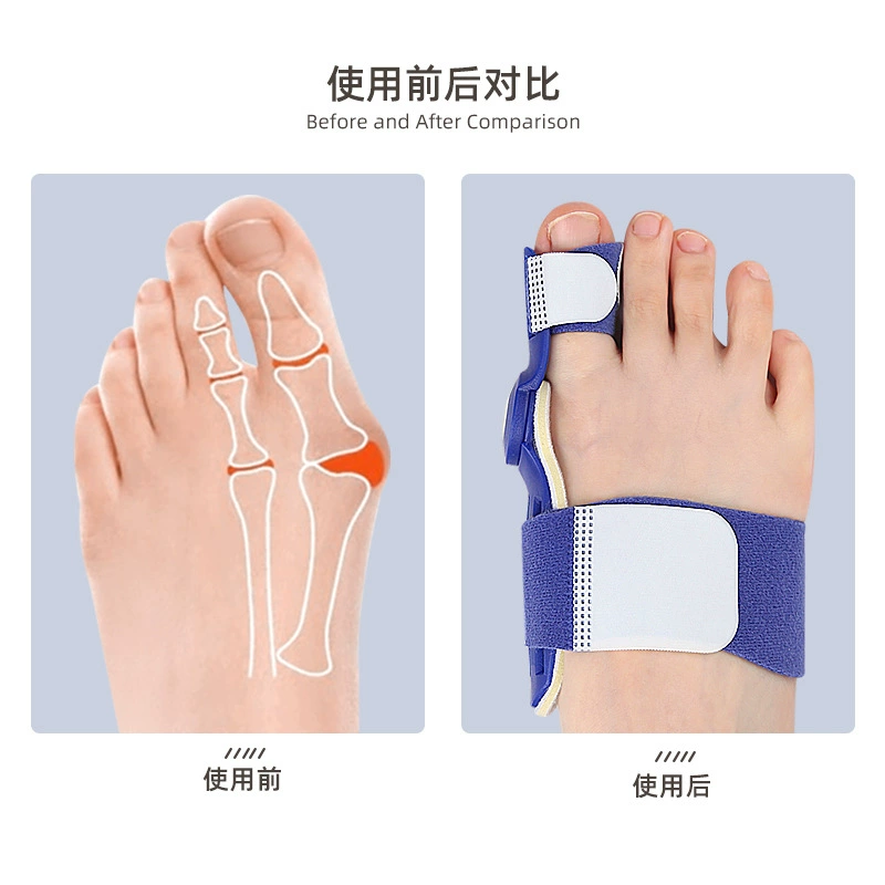 The thumb florer furry device with large foot bone heavy toe divide the toe can adjust the magic stick toe appliance