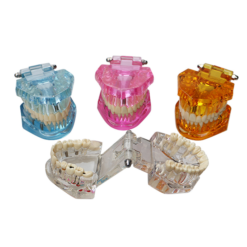 Herramienta de enseñanza de modelos dentales para la comunicación entre paciente y médico, molde dental transparente, modelo de explicación de implantes extraíble para niños.
