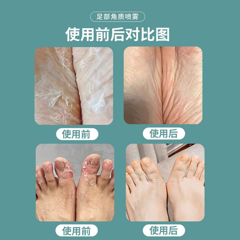足部角质喷剂厂家脚垫脚后跟厚茧喷雾软化足部老茧角质抑菌液批发|undefined