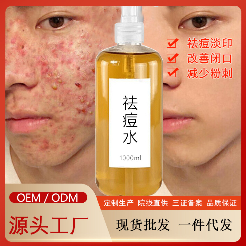 祛痘水精华液去闭口粉刺收缩毛孔淡化痘印控油净痘祛痘精华液院装