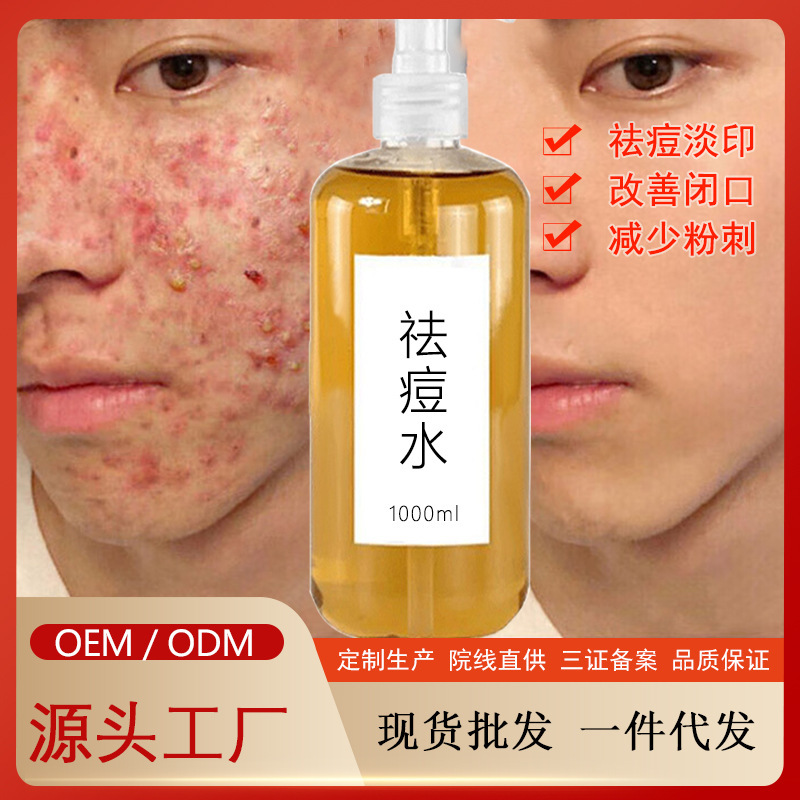 Acne Water Essence to Close the Mouth Acne Shrinking Pore Desalination Acne Seal Oil Control Anti-Acne Essence Hospital Acne Water Essence to Close the Mouth Acne Shrinking Pore Desalination Acne Seal Oil Control Anti-Acne Essence Hospital