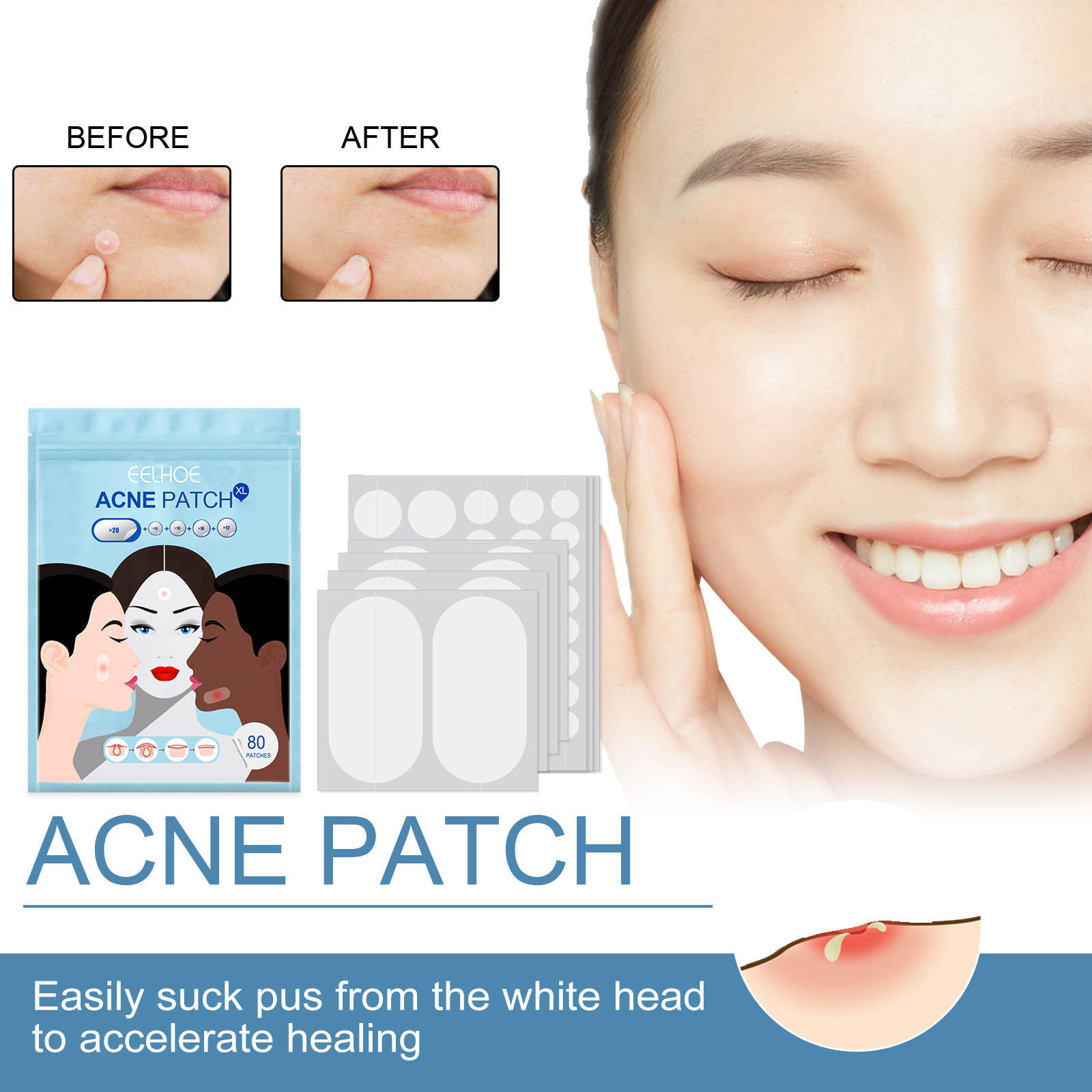 EELHOE Invisible Cleaning Patch Anti acne Closed mouth Acne Waterproof Topping concealer Hydrocolloid_voghion.com