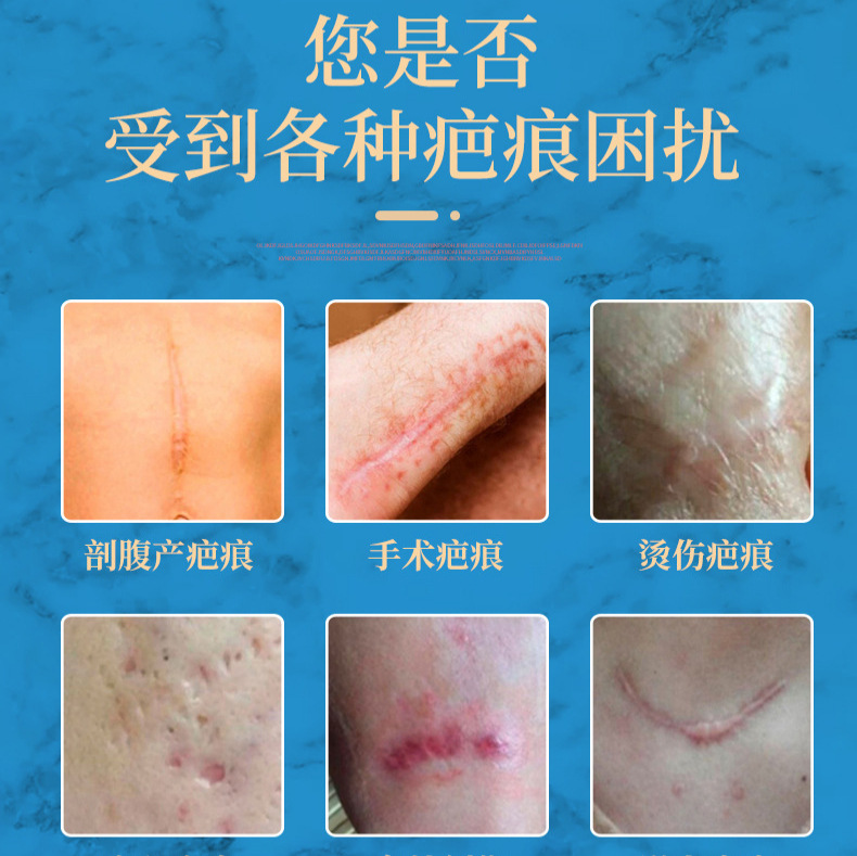 Crucero para eliminar el gel de la marca de la luz