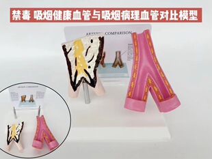 Vascular model vascular structure mold smoking harm health smoking vascular pathology vascular anatomy model