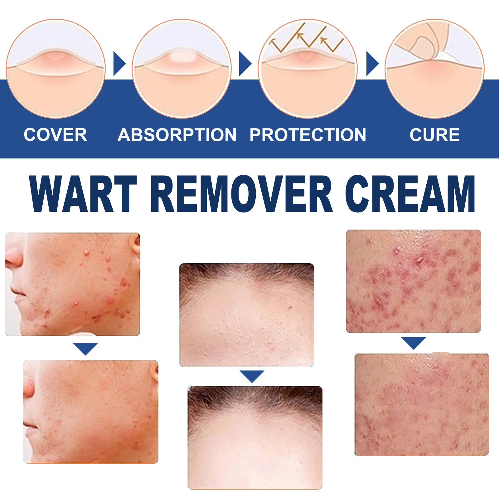 South Moon Pinghou Youke Wart Cream, Filamentous Warts, Acute Warts, Suppressing Wart Cream on Hands, Feet and Face_voghion.com