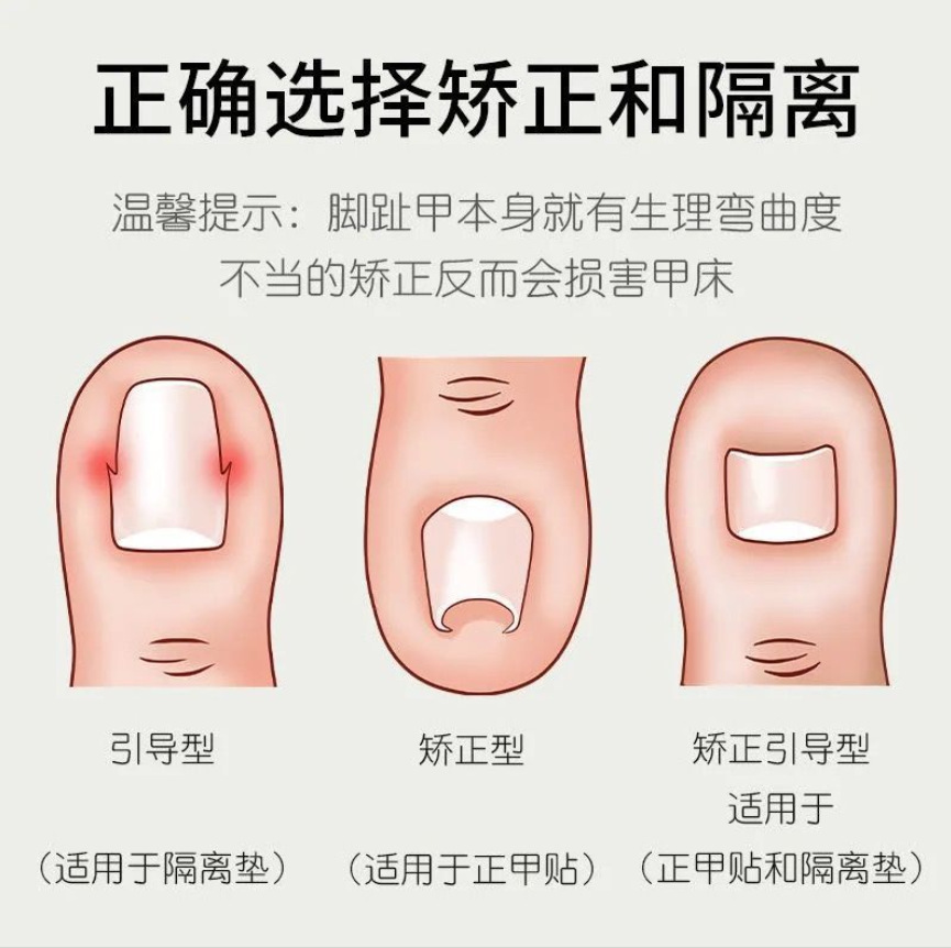 Corrector de Uñas Encarnadas de Plástico y Acero Inoxidable para Pedicura