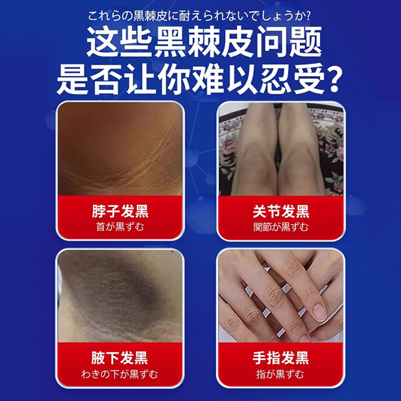 岩井昃弘去黑脖子黑色素沉淀症黑棘皮药膏脖颈关节黑肥胖洗不干净|undefined