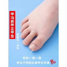 甲沟 炎矫正神器灰指甲专用脚趾套填充垫正甲扣贴片工具矫正器隔