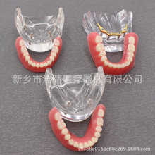 牙科口腔种植模型下颌牙2颗钉4颗钉种植模型 医患沟通展示模型