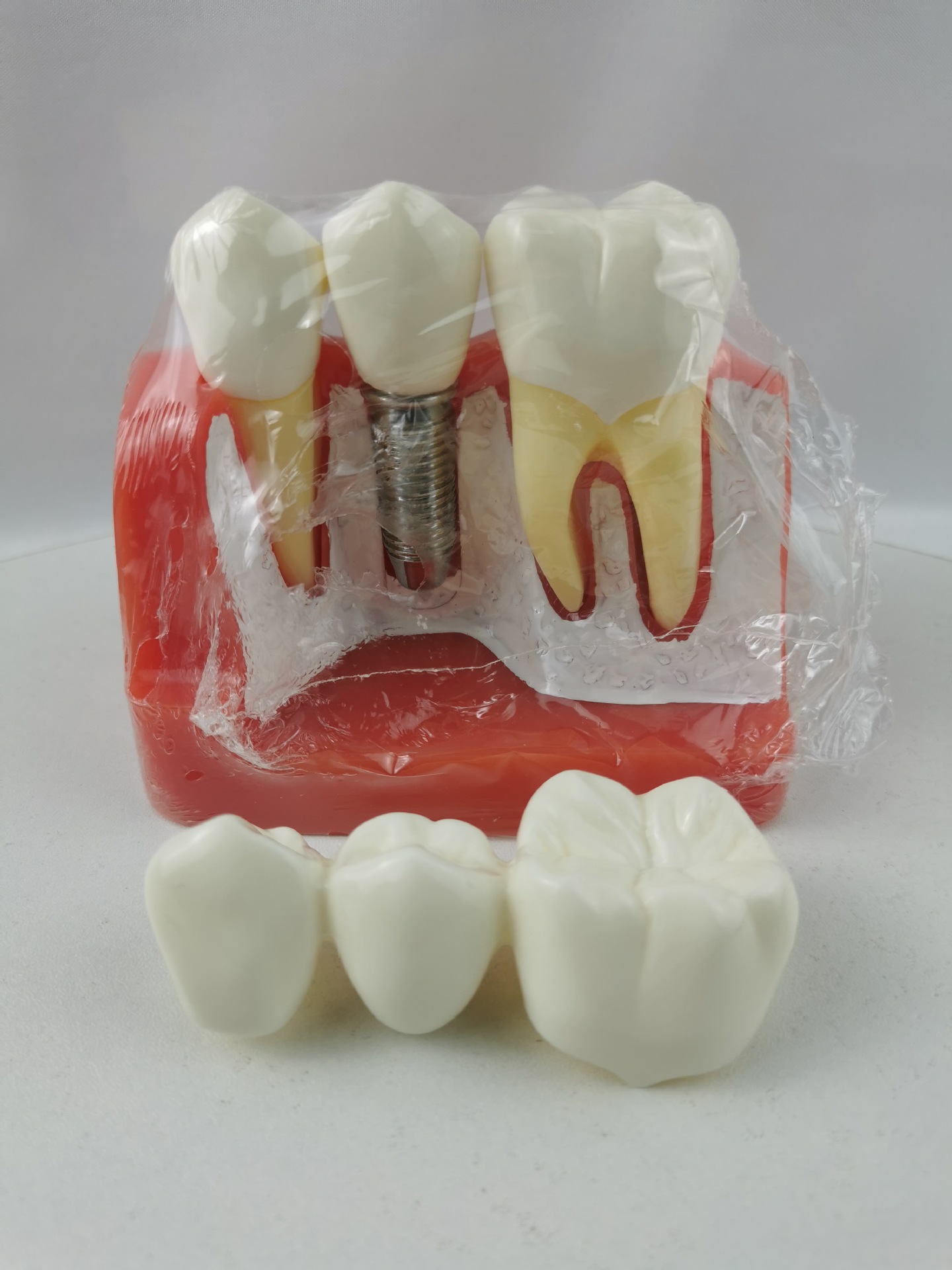 M2017R种植牙齿模型 牙冠可分离|ms