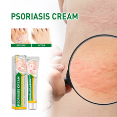West&Month スキンケアクリーム 皮膚の苔の除去 外用 かゆみ 蚊刺され 手足のかゆみ 水疱の緩和