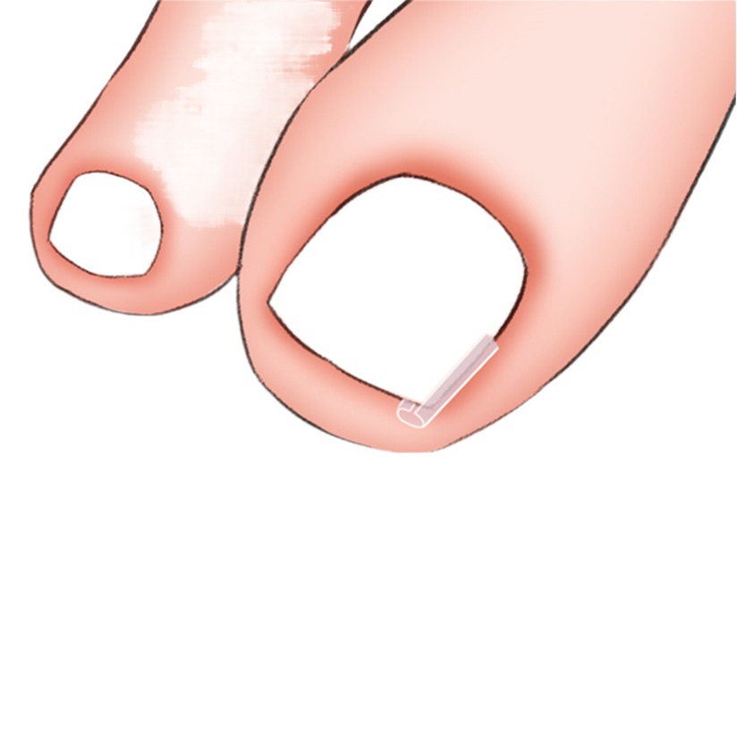 Almohadilla de uñas tipo C junta de uñas dedo del pie junta de relleno de uñas corrector de ranura de uñas palo de uñas forro de carne larga