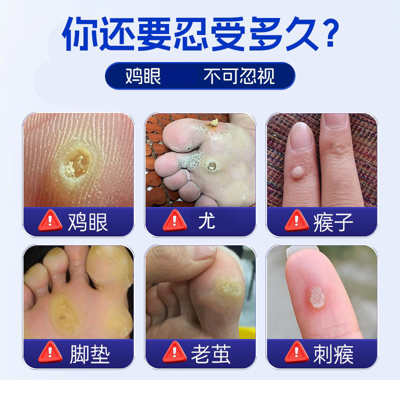 北京同仁堂鶏眼膏肉刺子繭足部看護鶏眼貼鶏眼膏|undefined