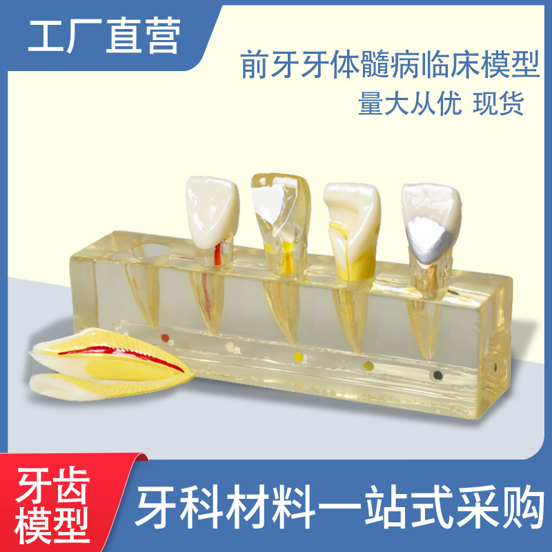 Modelo dental que enseña el modelo oral modelo clínico de la enfermedad de la pulpa del diente anterior modelo patológico