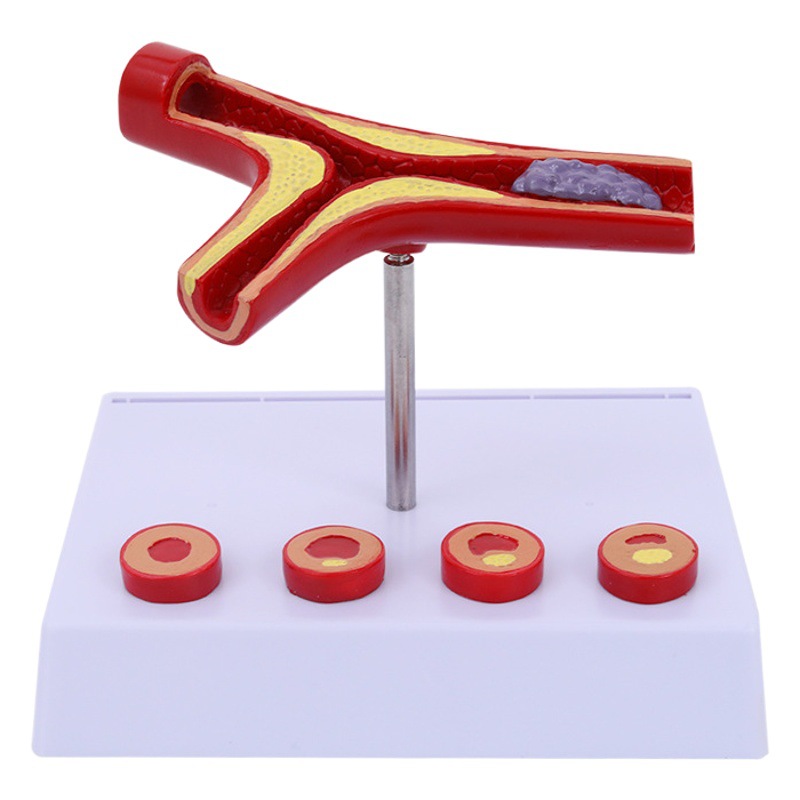 Modelo de la arteria coronaria Modelo de la arteria cardiovascular modelo de endurecimiento