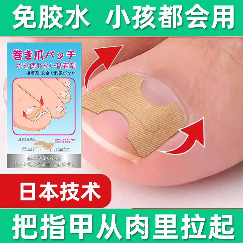 跨境免胶水矫正神器脚指甲长肉里正甲贴片甲沟嵌甲矫正器趾甲工具