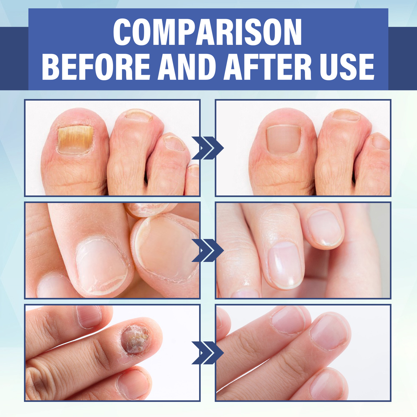 EELHOE repair LED phototherapy instrument for hand foot nails yellowing, soft repair, thickening, and smoothing of the_voghion.com