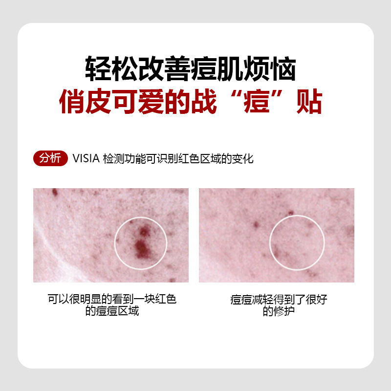 跨境卡通PE痘痘贴pimple遮瑕贴便携遮盖痘痘可化妆PE隐形遮瑕贴|undefined