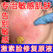 激素脸修复原去红血丝修复敏感肌增厚角质层积雪草去红血丝精华液