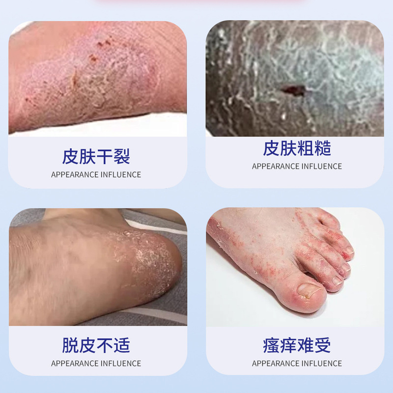 宫本田中真菌王外用保健膏脚臭足痒皮肤干裂/粗糙/脱皮不适批发|undefined