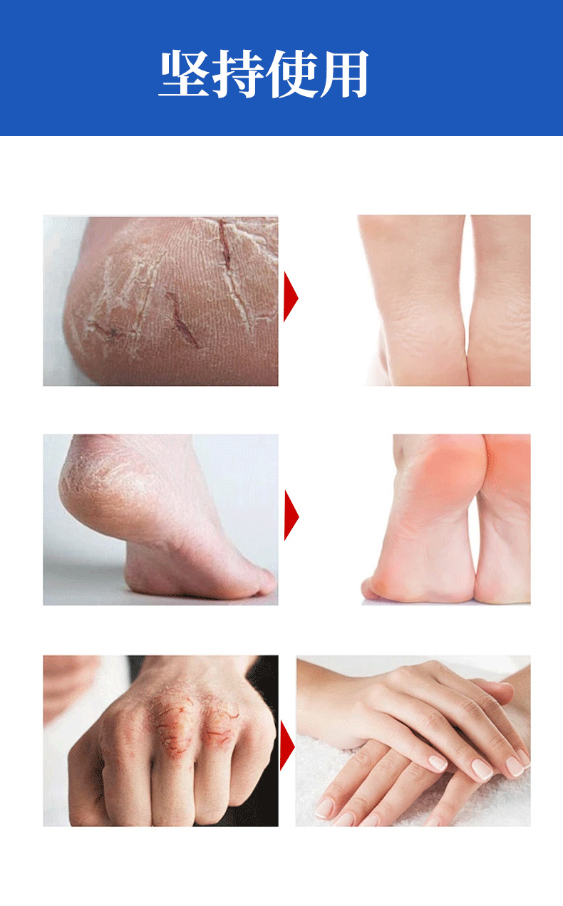 Yao Benren Vitamin E Horse Oil Cracked Skin Ointment 20g External Skin Care Salve in use