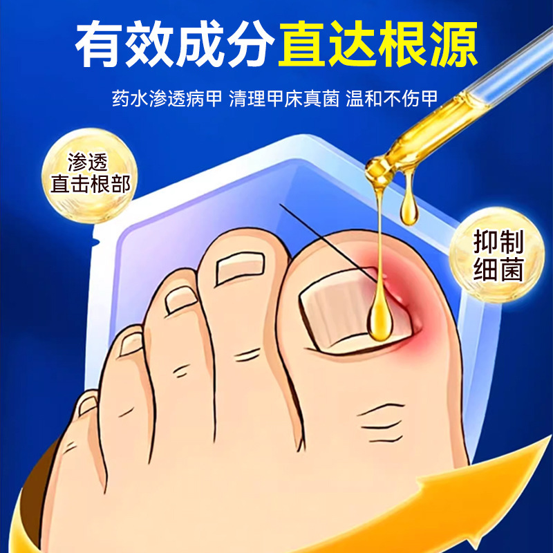 Teyijia Angel Skin 抗菌液体手足指爪真菌除去クリーム爪除去液体柔らかい爪肥厚と爪の除去|undefined