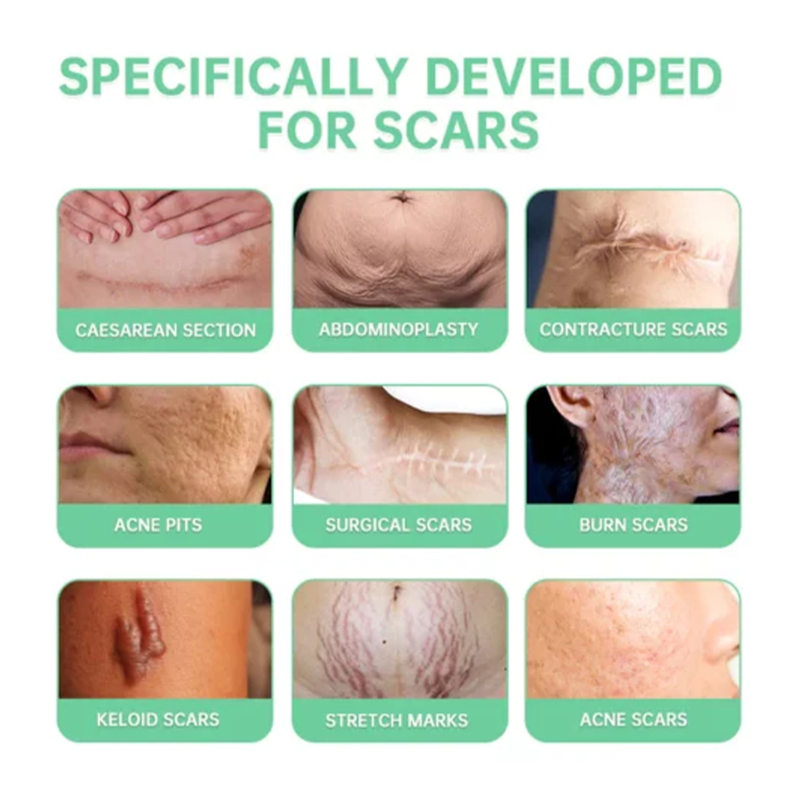 desalinates scars  pregnancy scar moisturizing repair smoothing skin care spray_voghion.com