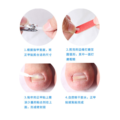 Ingrown toenail corrector set, Nail and groove pliers, Nail correction wire to correct toenails