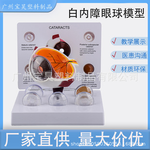 Ophthalmology Doctor-Patient Explanation Model Eyeball Model Pathological Eyeball Evolution Model Eyeball Lesion Model