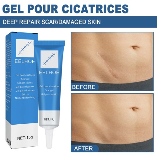 EELHOE Scar Repair Gel External Cold Compress Cream Skin Damage Repair Type Softens, Smoothes and Moisturizes Scars