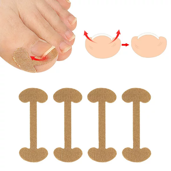 Nail cotton toenail nail groove nail inlay nail device thumb nail patch fast toenail repair deformation meat bag