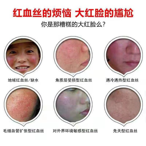 Centella asiatica repair cream removes redness, thickens cuticles, repairs sensitive muscles, hormones, face repair cream, beauty salon
