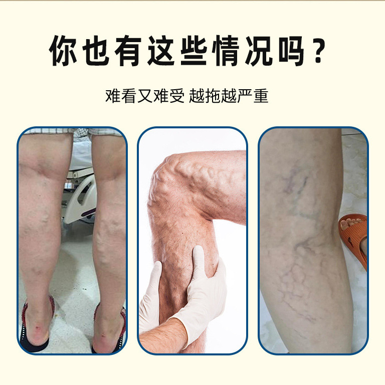 香港薬局苗家静脈スプレー静脈瘤スプレー静脈瘤緩和スプレーパッチ卸売|undefined